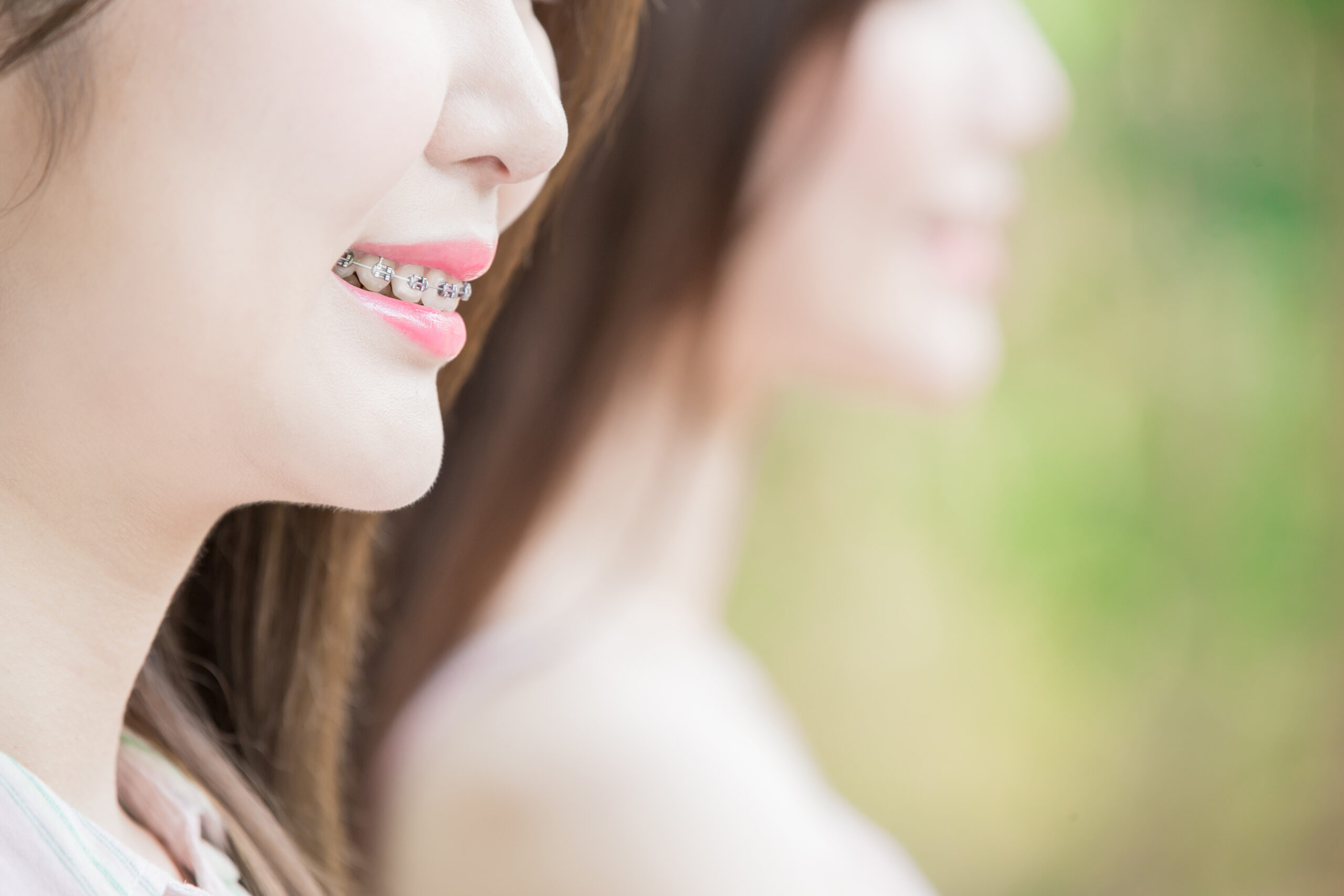 口元の膨らみ（口ゴボ）を矯正で治す方法｜原因・治療のステップ、注意点を徹底解説